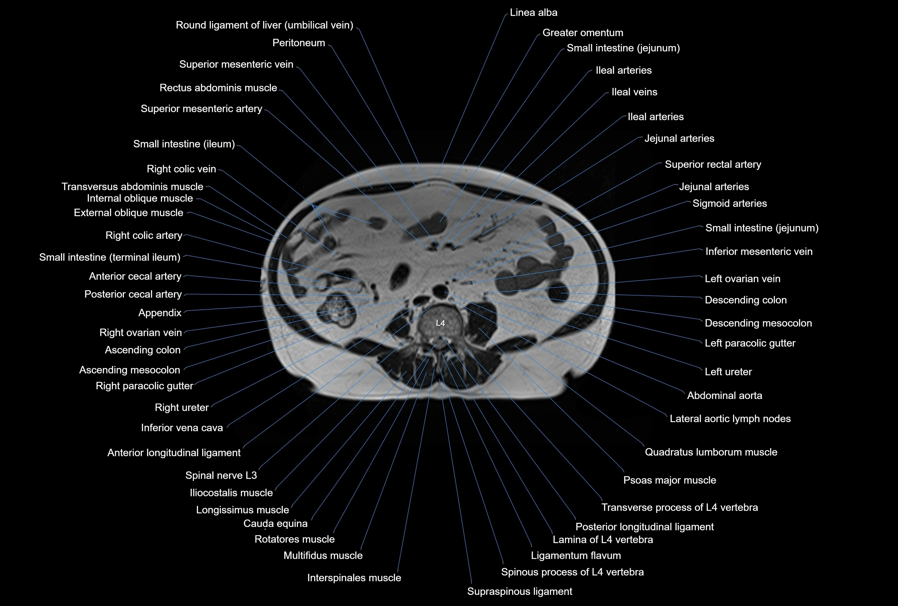 MRI Abdomen axial cross sectional anatomy radiology  image-img-00001-00031.webp